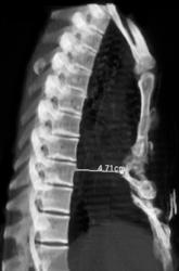 Pectus Excavatum - CTisus CT Scan