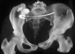 Pelvic Fractures - CTisus CT Scan