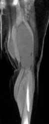 Liposarcoma - CTisus CT Scan