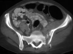 Osteomyelitis Left SI Joint - CTisus CT Scan