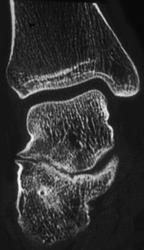 Degenerative Arthritis Talo-calcaneal Joint - CTisus CT Scan