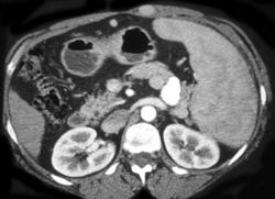 Varices Within Rectus Muscle - CTisus CT Scan