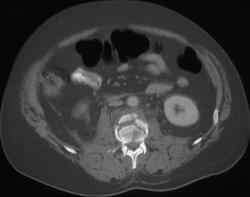 Vertebral Compression Fracture - CTisus CT Scan