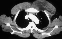 Chest Wall Abscess With Myositis - CTisus CT Scan