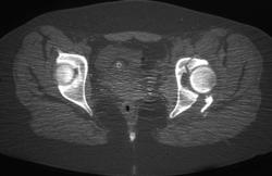 Left Acetabular Fracture - CTisus CT Scan