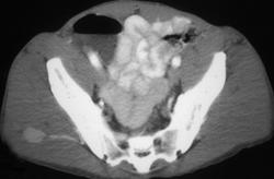 Bleed in Gluteal Muscle - CTisus CT Scan