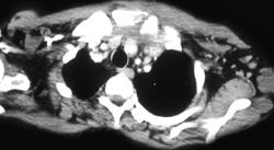 Osteomyelitis Left S/c Joint With Abscess - CTisus CT Scan