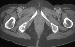 Lymphoma Ischium - CTisus CT Scan