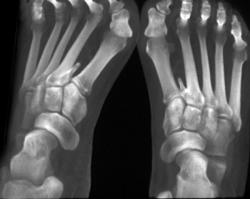 Extra Digit - CTisus CT Scan