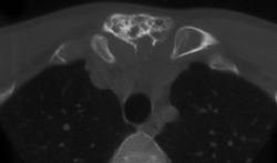 Amyloidosis - CTisus CT Scan