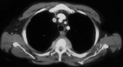 Lymphoma - CTisus CT Scan