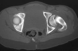 Left Slipped Capital Femoral Epiphysis (SCFE) - CTisus CT Scan