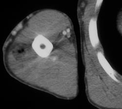 Abscess - CTisus CT Scan