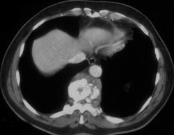 Osteomyelitis - CTisus CT Scan