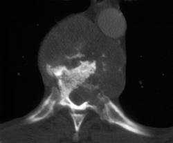 Osteomyelitis - CTisus CT Scan