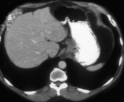 Metastases to the Spine - CTisus CT Scan