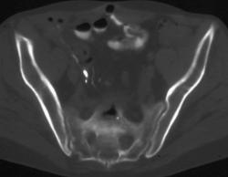 Crohn's With Osteomyelitis Sacrum - CTisus CT Scan