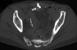 Crohn's With Sacral Osteomyelitis and Presacral Abscess - CTisus CT Scan