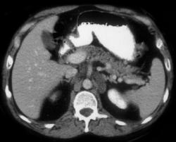 Neurofibromatosis - CTisus CT Scan