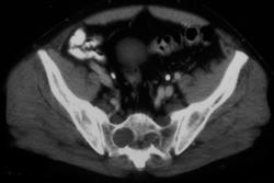 Neurofibromatosis - CTisus CT Scan