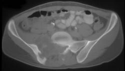 Tuberculosis (TB) Osteomyelitis - CTisus CT Scan