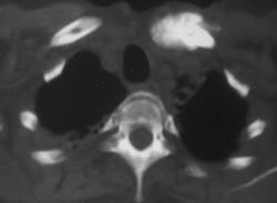 Radiation Induced Sarcoma - CTisus CT Scan