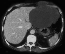 Chondrosarcoma - CTisus CT Scan