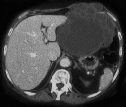 Chondrosarcoma - CTisus CT Scan