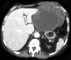 Chondrosarcoma - CTisus CT Scan