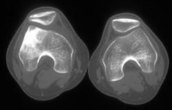 Bone Infarct - CTisus CT Scan