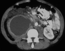 Psoas Abscess - CTisus CT Scan