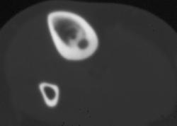 Radiofrequency Ablation (RFA) of Osteoid Osteoma - CTisus CT Scan