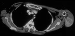 Muscle Metastases From Renal Cell Carcinoma - CTisus CT Scan