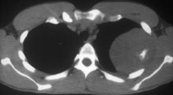 Ewing Sarcoma - CTisus CT Scan