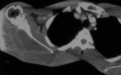 Abscess - CTisus CT Scan