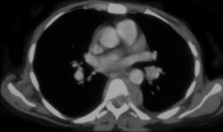 Neurofibromatosis - CTisus CT Scan