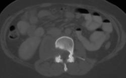 Neurofibromatosis - CTisus CT Scan