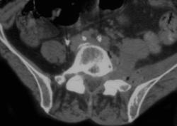 Abscess in Left Iliopsoas Muscle - CTisus CT Scan