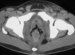 Fourniers Gangrene - CTisus CT Scan