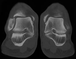 Tarsal Coalition - CTisus CT Scan