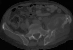 Sarcoma in Pagetoid Bone - CTisus CT Scan