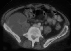 Iliopsoas Abscess - CTisus CT Scan