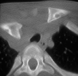 Posterior Right Clavicular Dislocation - CTisus CT Scan