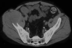 Biopsy of Sarcoma - CTisus CT Scan