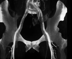 Ct Angioma Post Trauma - CTisus CT Scan