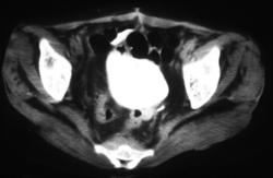 Extramedullary Hematopoiesis (thallasemia) - CTisus CT Scan