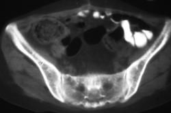 Extramedullary Hematopoiesis - CTisus CT Scan