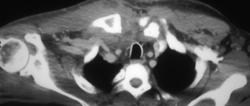 Abscess Right S/c Joint - CTisus CT Scan