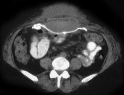 Abscess Following Hernia Repair With Mesh - CTisus CT Scan