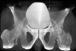 3D of Bladder With CT Cystogram - CTisus CT Scan